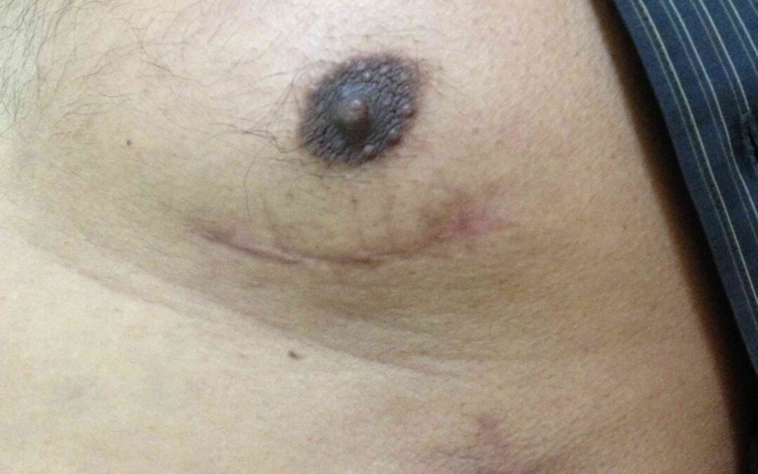 MICS CABG