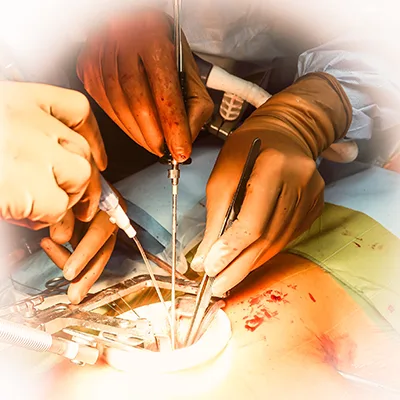 MICSCABG Minimally Invasive Cardiac Surgery