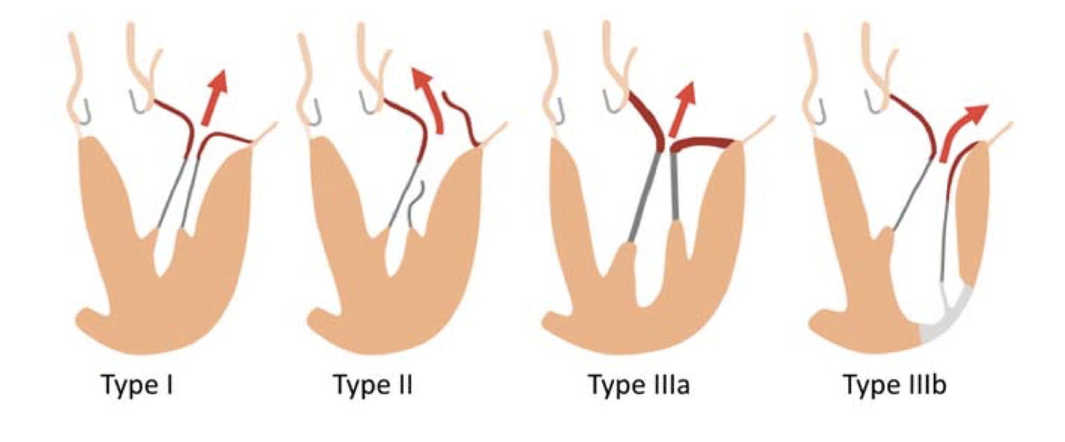 Classification of Mitral Regurgitation MICS