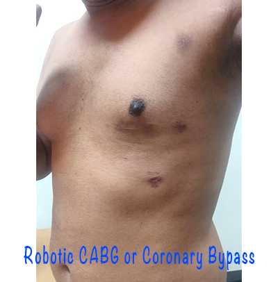 Robotic CABG Robotic CABG by Dr Sathyaki Nambala