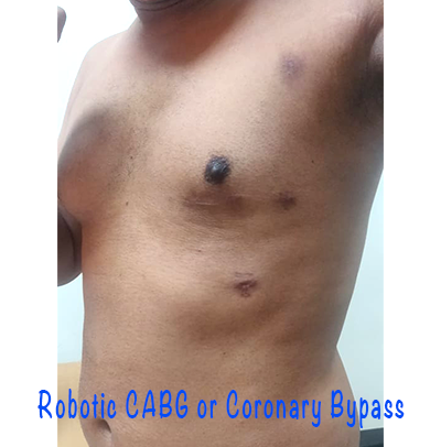 Robotic CABG by Dr Sathyaki Nambala