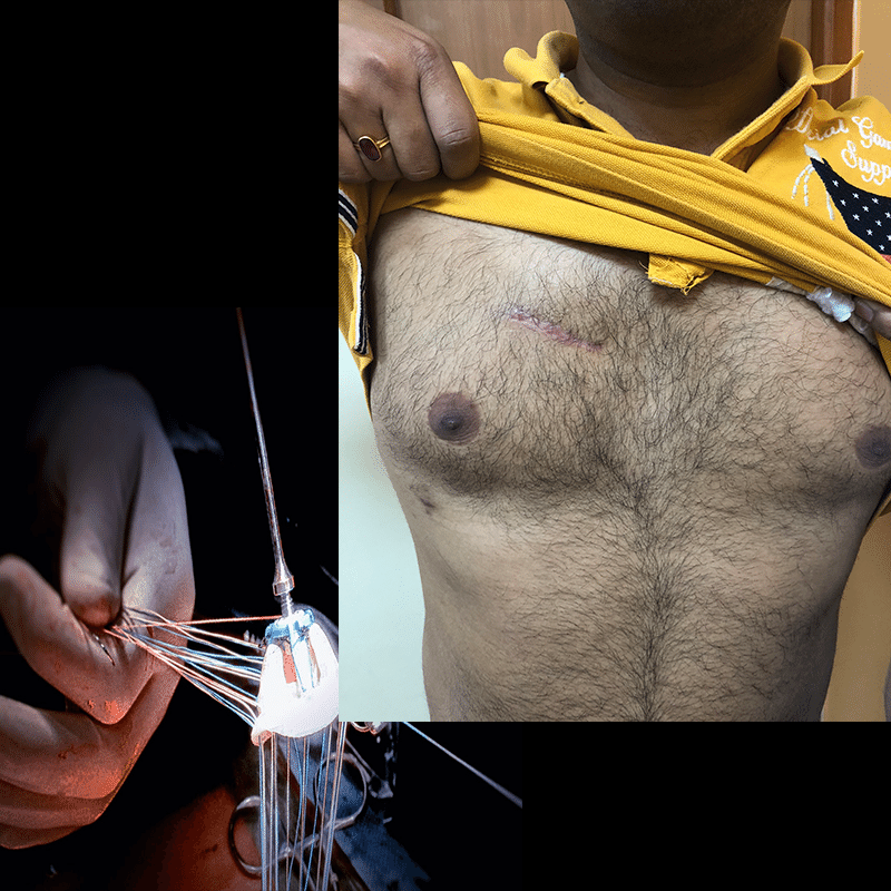 AVR2SMALL MINIMALLY INVASIVE AVR