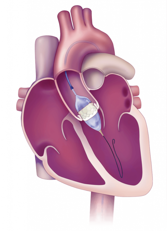 Minimally Invasive Aortic Valve Replacement (AVR): No 1 alternative to open surgery. 7 Upper Hemi