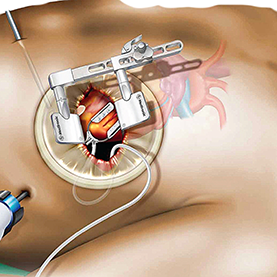 MICS CABG illustration