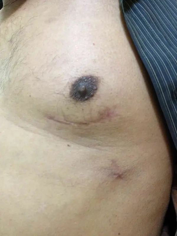 Robotic CABG