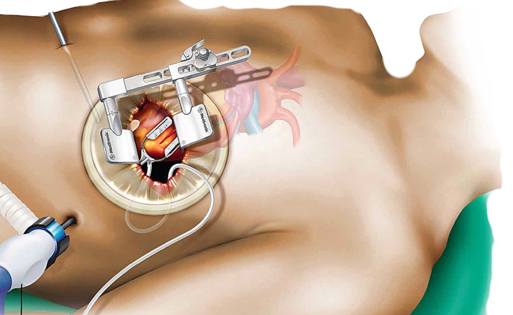 MICS CABG illustration MICS