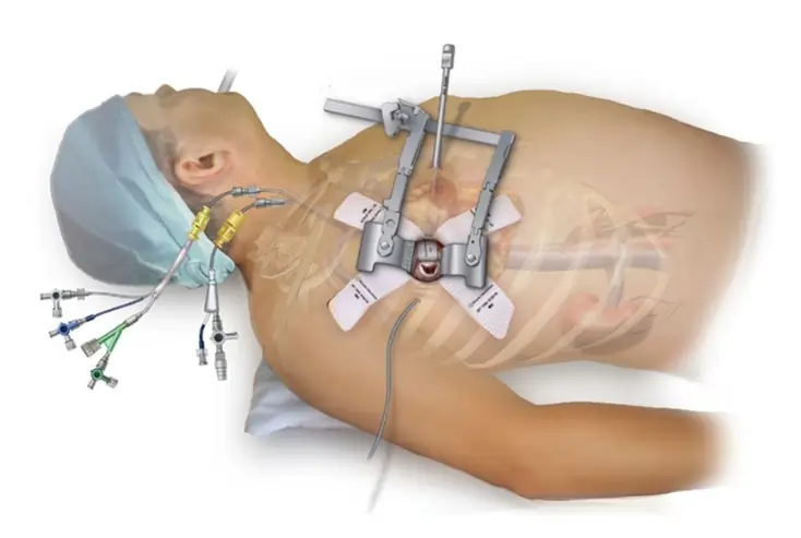 Minimally Invasive Mitral Valve Surgery