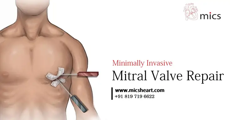 minimally invasive mitral valve repair