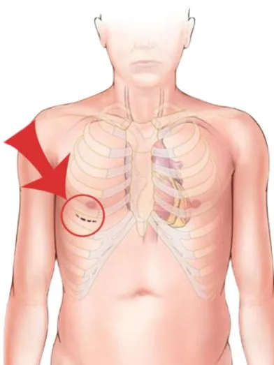 Minimally Invasive Valve Replacement: A Less Invasive Approach to Heart Valve Surgery