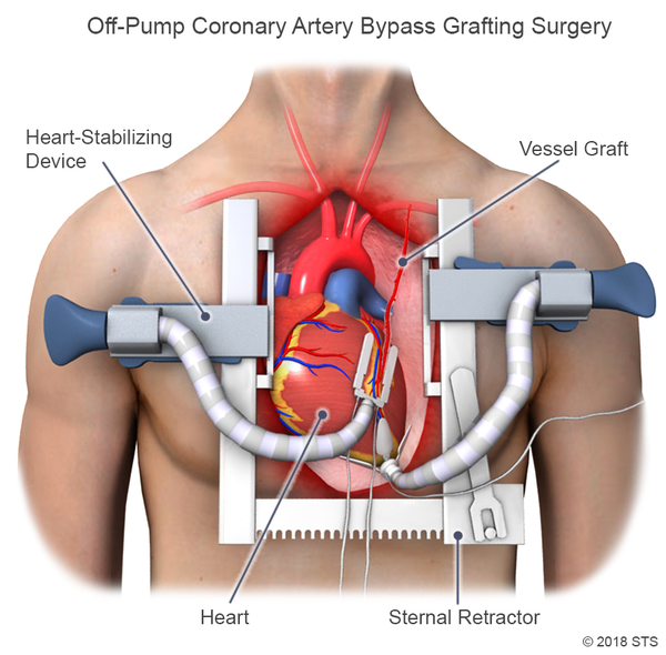 OPEN CABG MICS