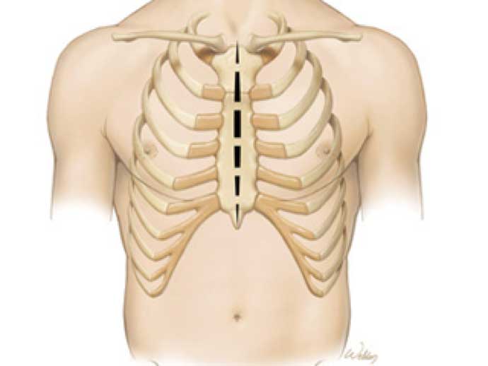 Sternotomy MICS