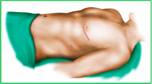 MICS CABG MICS CABG