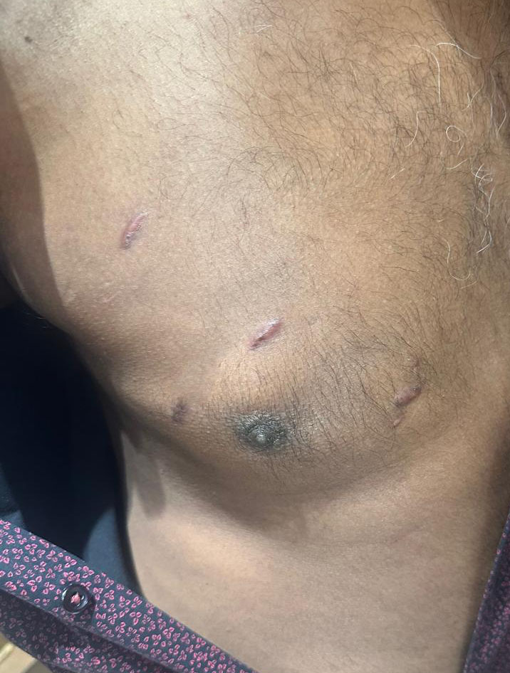 Robotic Aortic Valve Replacement